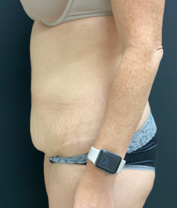 Abdominoplasty (Tummy Tuck) Before and After Pictures Buffalo, NY