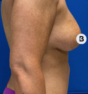 Breast Augmentation Before and After Pictures Buffalo, NY