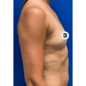 Breast Augmentation Before and After Pictures Buffalo, NY