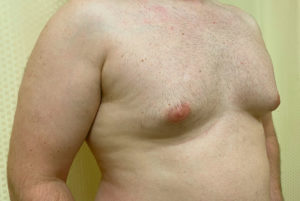 Gynecomastia (Male Chest Surgery) Before and After Pictures Buffalo, NY