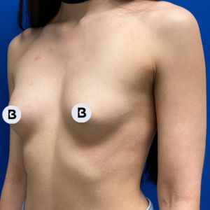 Breast Augmentation Before and After Pictures Buffalo, NY