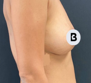 Breast Augmentation Before and After Pictures Buffalo, NY