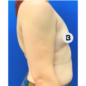 Breast Augmentation Before and After Pictures Buffalo, NY