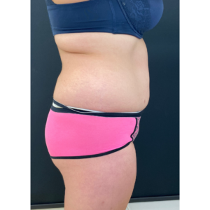 Brazilian Butt Lift Before and After Pictures Buffalo, NY