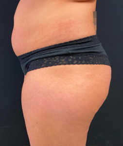 Brazilian Butt Lift Before and After Pictures in Buffalo, NY