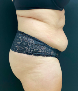 Abdominoplasty (Tummy Tuck) Before and After Pictures Buffalo, NY
