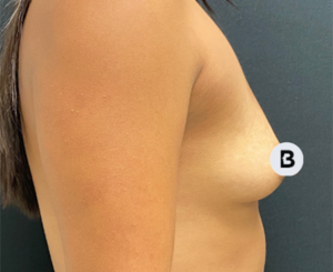 Breast Augmentation Before and After Pictures Buffalo, NY