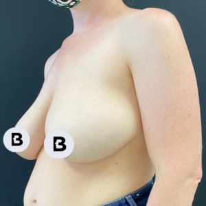 Breast Reduction Before and After Pictures Buffalo, NY