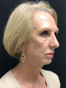Facelift Before and After Pictures in Buffalo, NY