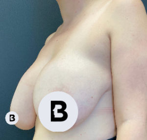 Breast Reduction Before and After Pictures Buffalo, NY