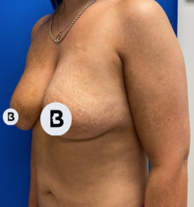 Breast Augmentation Before and After Pictures Buffalo, NY