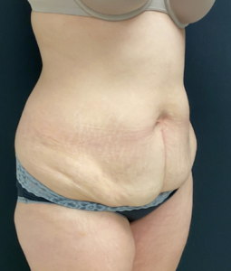 Abdominoplasty (Tummy Tuck) Before and After Pictures Buffalo, NY