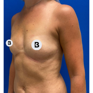 Breast Augmentation Before and After Pictures Buffalo, NY