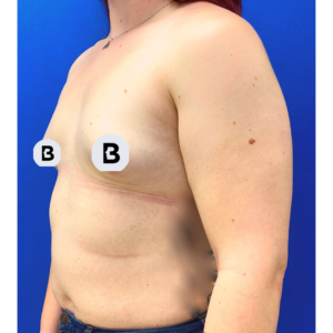 Breast Augmentation Before and After Pictures Buffalo, NY
