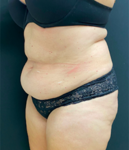 Abdominoplasty (Tummy Tuck) Before and After Pictures Buffalo, NY