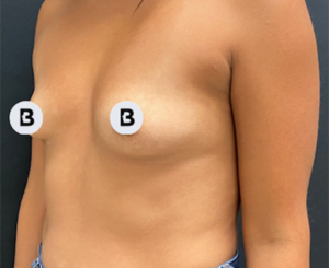 Breast Augmentation Before and After Pictures Buffalo, NY