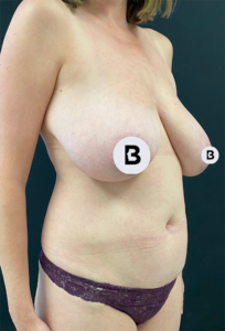 Liposuction Before and After Pictures in Buffalo, NY