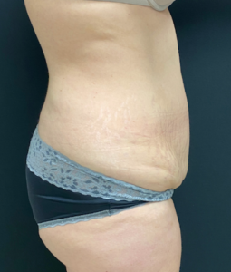 Abdominoplasty (Tummy Tuck) Before and After Pictures Buffalo, NY