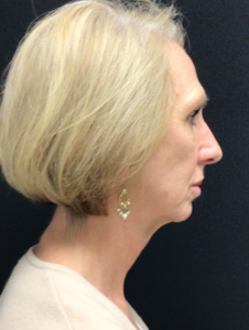 Facelift Before and After Pictures in Buffalo, NY