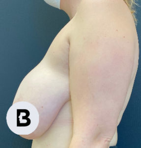 Breast Reduction Before and After Pictures Buffalo, NY