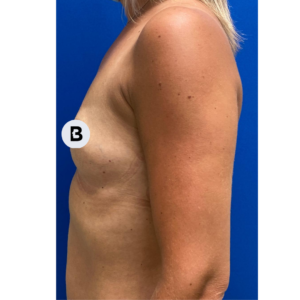 Breast Augmentation Before and After Pictures Buffalo, NY