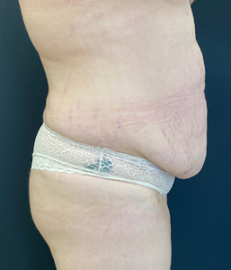 Abdominoplasty (Tummy Tuck) Before and After Pictures Buffalo, NY