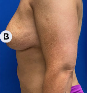 Breast Augmentation Before and After Pictures Buffalo, NY