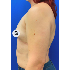 Breast Augmentation Before and After Pictures Buffalo, NY