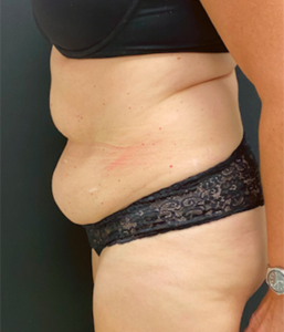 Abdominoplasty (Tummy Tuck) Before and After Pictures Buffalo, NY
