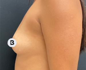 Breast Augmentation Before and After Pictures Buffalo, NY