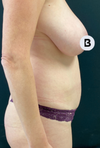 Liposuction Before and After Pictures in Buffalo, NY