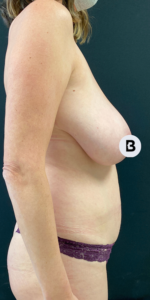 Mastopexy (Breast Lift) Before and After Pictures in Buffalo, NY