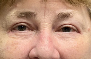 Blepharoplasty (Eyelid Surgery) Before and After Pictures Buffalo, NY