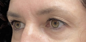 Blepharoplasty (Eyelid Surgery) Before and After Pictures in Buffalo, NY