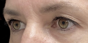 Blepharoplasty (Eyelid Surgery) Before and After Pictures in Buffalo, NY