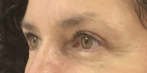 Blepharoplasty (Eyelid Surgery) Before and After Pictures in Buffalo, NY
