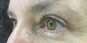 Blepharoplasty (Eyelid Surgery) Before and After Pictures in Buffalo, NY