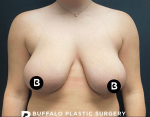 Breast Reduction Before and After Pictures in Buffalo, NY