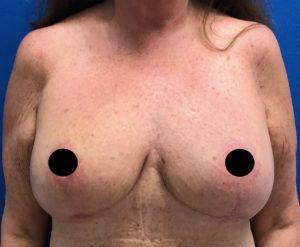 Mastopexy (Breast Lift) Before and After Pictures Buffalo, NY