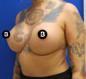 Breast Augmentation Before and After Pictures Buffalo, NY