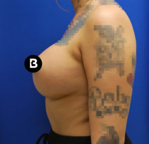 Breast Augmentation Before and After Pictures Buffalo, NY