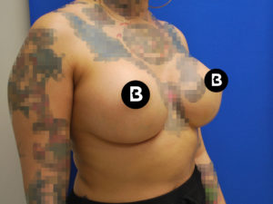 Breast Augmentation Before and After Pictures Buffalo, NY
