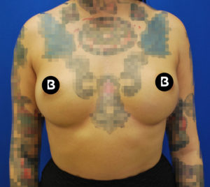 Breast Augmentation Before and After Pictures Buffalo, NY
