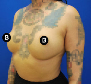Breast Augmentation Before and After Pictures Buffalo, NY