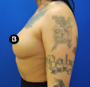Breast Augmentation Before and After Pictures Buffalo, NY