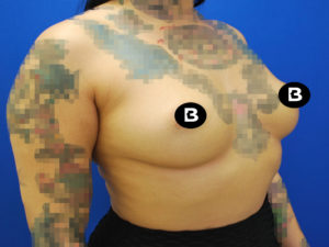 Breast Augmentation Before and After Pictures Buffalo, NY