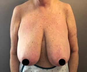 Mastopexy (Breast Lift) Before and After Pictures Buffalo, NY