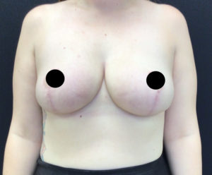 Mastopexy (Breast Lift) Before and After Pictures in Buffalo, NY