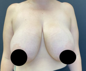 Mastopexy (Breast Lift) Before and After Pictures in Buffalo, NY