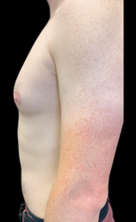 Before Gynecomastia